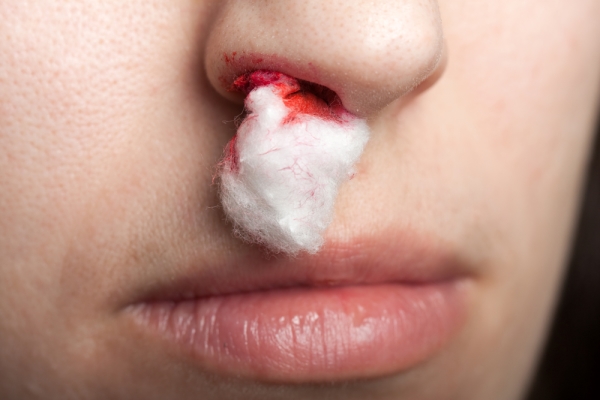 Почему из носа идёт кровь? Как её правильно остановить: рекомендации врачей