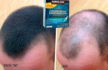 Миноксидил - средство для роста волос