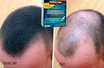 Миноксидил - средство для роста волос