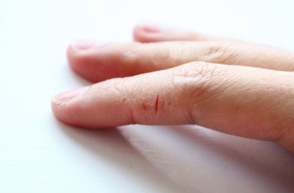 Трещины на пальцах рук: отчего и как лечить?