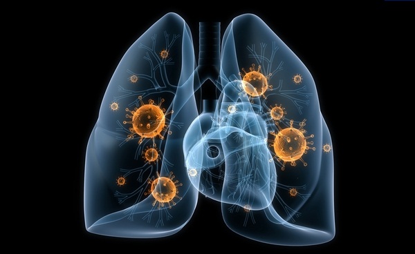 Симптомы и лечение воспаления лёгких
