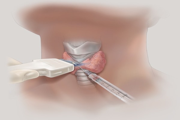 Биопсия щитовидки